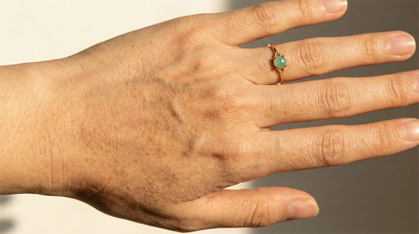 hiperpigmentasi tangan 2 resize